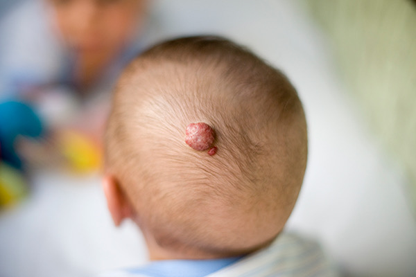 Hình ảnh: Thoát vị não ở trẻ em